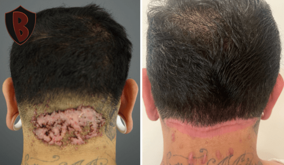 This young man had a family history of AKN, and was able to get his lesion removed with Dr. Bumpinator’s help.*