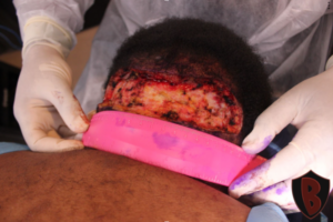 Dr. Bumpinator used his Athena suture guard assisted bat excision technique to remove the AKN lesion. *