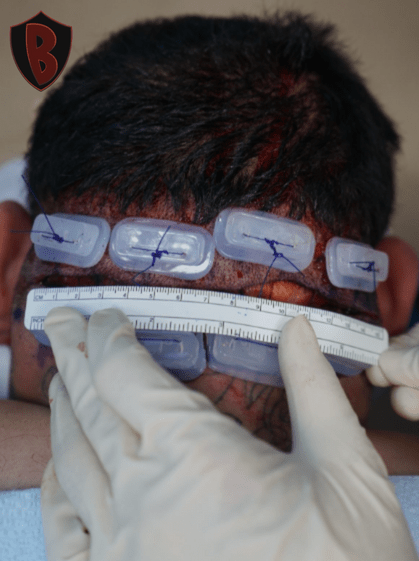 Figure 2 Dr. Bumpinator used his patented Athena suture guards for this AKN removal procedure.