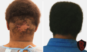 flat follicular plaque