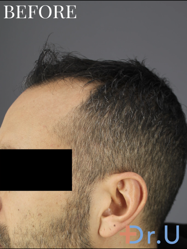 the patient need to restore hair in his hairline and mid-scalp.