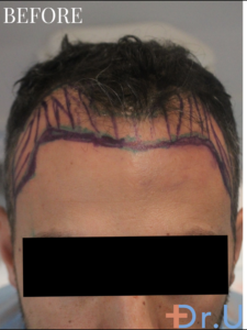 Dr. Umar drew the patient's hairline before starting the surgery.*