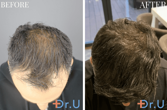 The young man left Dr. U Hair and Skin Clinic with a renewed sense of confidence.
