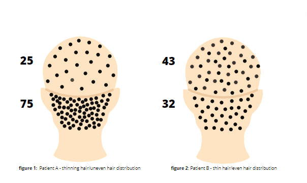 The graphic demonstrates how uneven distribution of hair on the head creates an illusion of balding while having less hair that's more evenly distributed looks better.