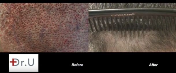FUE donor area immediately after surgery (Left). FUE donor area at 1 year after surgery, showing no visual evidence of scarring (Right)