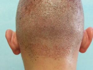 FUE donor area, immediately after harvesting 3500 grafts. Tiny dot wounds are left behind that heal without stitches. 