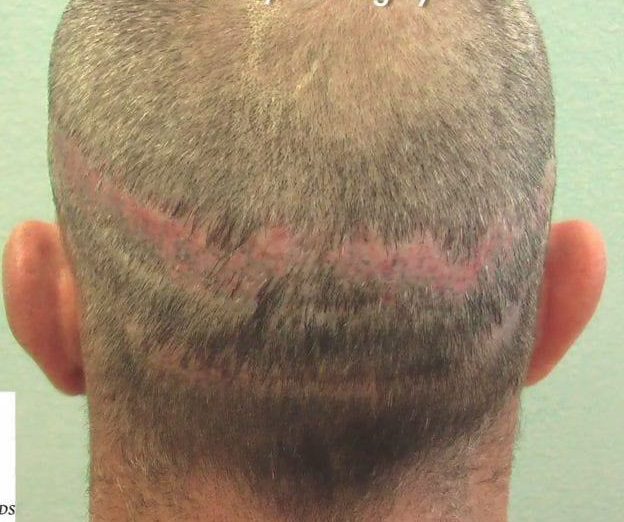 Stretched FUT scar. A fairly common occurrence requiring surgical intervention to camouflage