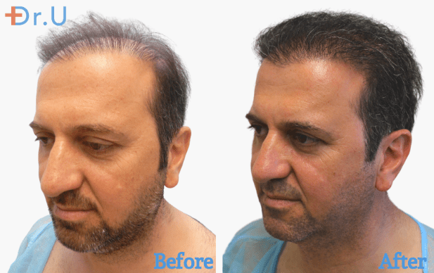 This patient didn’t have enough head hair to be used as donor. Dr. Umar used his chest hair to repair his hairline and provide fuller head coverage. *