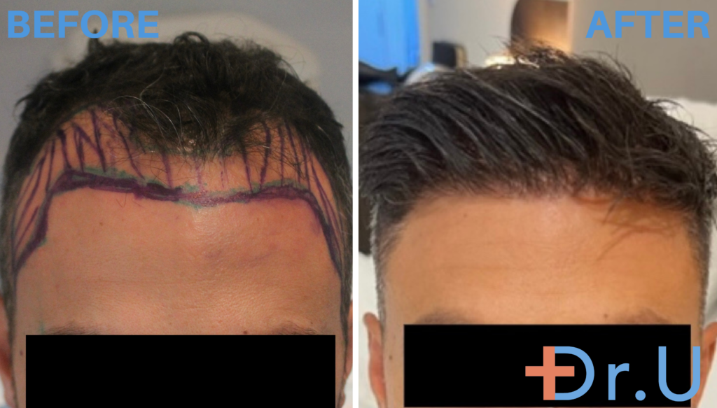 The young man left Dr. U Hair and Skin Clinic with a renewed sense of confidence after his hair restoration surgery.