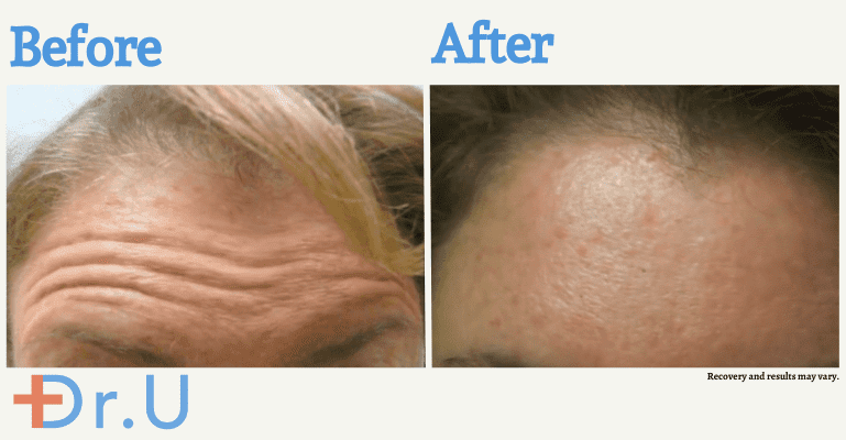 Dr. Umar used Botox to help this patient achieve a smoother, tighter, more youthful-looking forehead. Daxxify is another neurotoxin that was recently approved by the FDA.