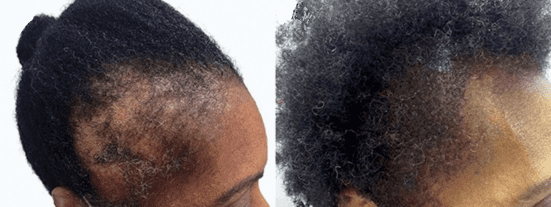 The Afro-Brazilian woman had temple hair loss from advanced traction alopecia. Her results are seen 7 month after her FUE hair transplant surgery with the UGraft Zeus. The Afro-Brazilian woman had temple hair loss from advanced traction alopecia. Her results are seen 7 month after her FUE hair transplant surgery with the UGraft Zeus.