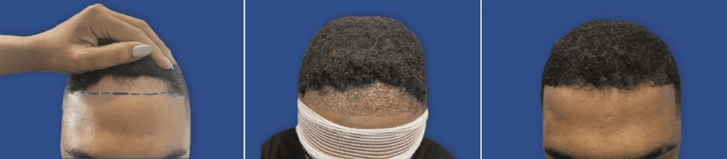 An African-American man with hairline recession (left), immediately after FUE hair transplant surgery with the UGraft Zeus (center), and 10 months post-surgery (right).* An African-American man with hairline recession (left), immediately after FUE hair transplant surgery with the UGraft Zeus (center), and 10 months post-surgery (right).*