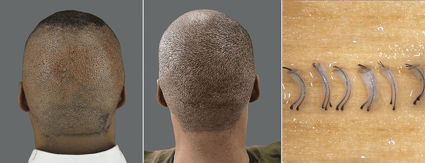 An African-American man, with thick, firm skin, mild acne keloidalis nuchae, and coily hair pre-surgery (left), 1 year post-surgery (center), and extraced hair grafts (right).* An African-American man, with thick, firm skin, mild acne keloidalis nuchae, and coily hair pre-surgery (left), 1 year post-surgery (center), and extraced hair grafts (right).*