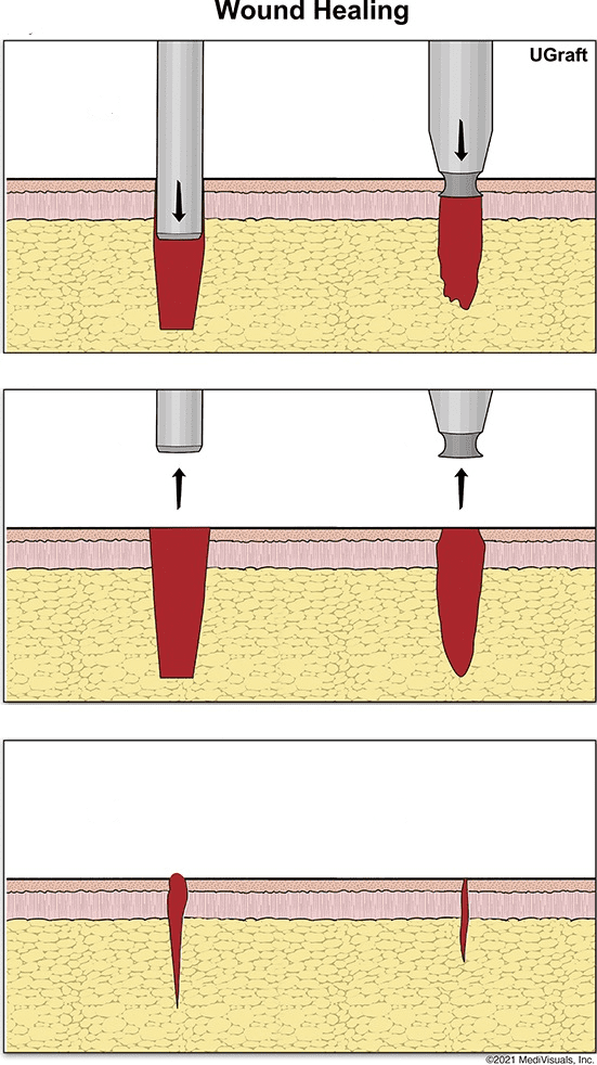 On the left, wounding and healing with a traditional FUE punch. On the right, wounding and healing with the UGraft Zeus. On the left, wounding and healing with a traditional FUE punch. On the right, wounding and healing with the UGraft Zeus.