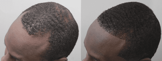 An African-American man pre- and post-FUE. His results are seen 13 months after the procedure (on the right). The UGraft Zeus was used for graft extraction.*