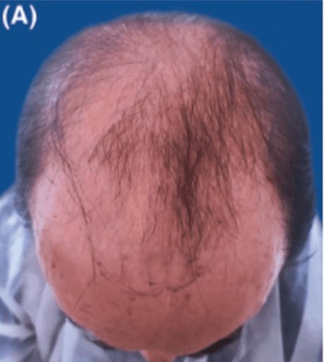 The patient was suffering from NW VI-VII male pattern baldness (MPB). The patient was suffering from NW VI-VII male pattern baldness (MPB).