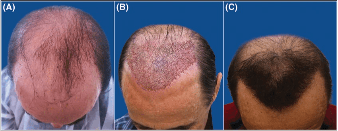 (A) Patient pre-surgery. (B) Patient immediately after grafting the frontal scalp area. (C) Patient 9 months post-surgery. * (A) Patient pre-surgery. (B) Patient immediately after grafting the frontal scalp area. (C) Patient 9 months post-surgery. *
