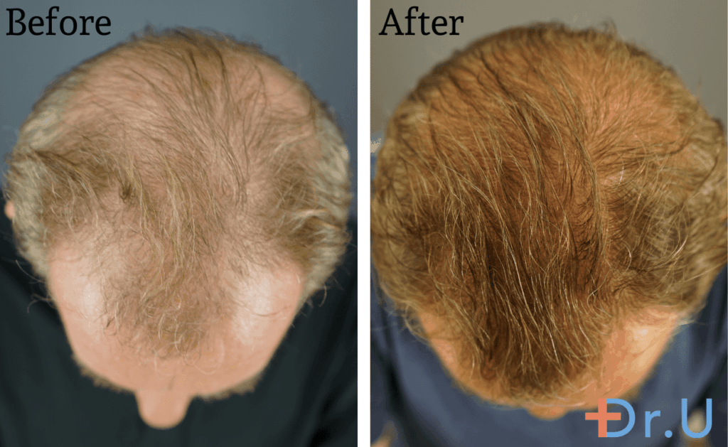 After consistently using Gashee products for 10 months, the patient saw significant natural hair growth. 