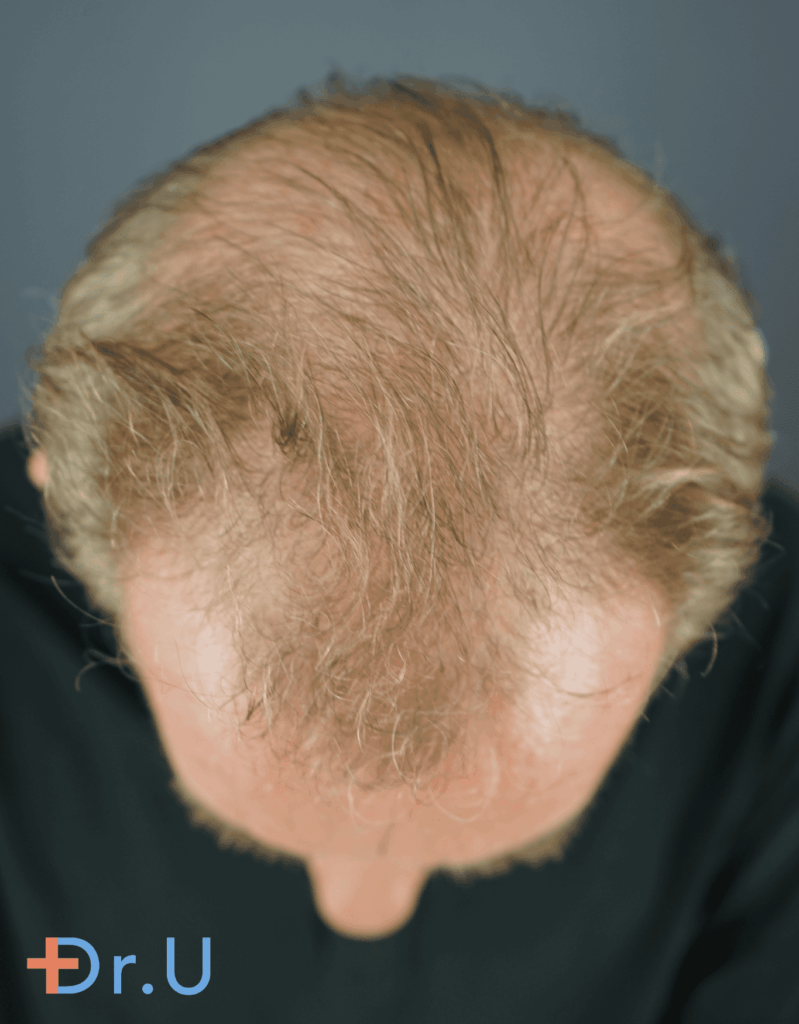 The patient suffered from hair loss and assumed his only solution was a hair transplant. 