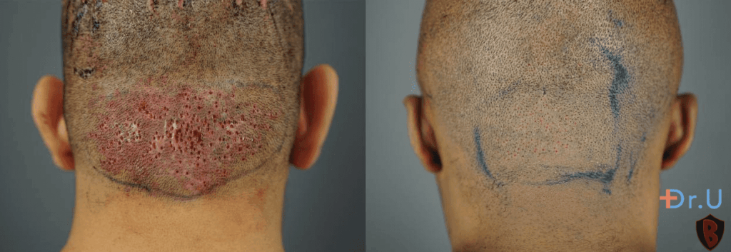Hispanic male patient seen with tiny wounds secondary to FUE procedure, taken immediately after surgery for papular AKN (left). African male patient with tiny wounds secondary to FUE procedure, taken immediately after surgery for papular AKN (right). Hispanic male patient seen with tiny wounds secondary to FUE procedure, taken immediately after surgery for papular AKN (left). African male patient with tiny wounds secondary to FUE procedure, taken immediately after surgery for papular AKN (right).