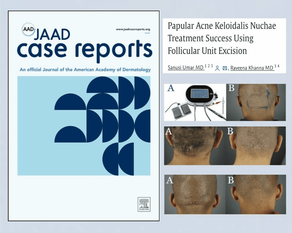 The groundbreaking study was published in the JAAD Case Reports journal. The groundbreaking study was published in the JAAD Case Reports journal.