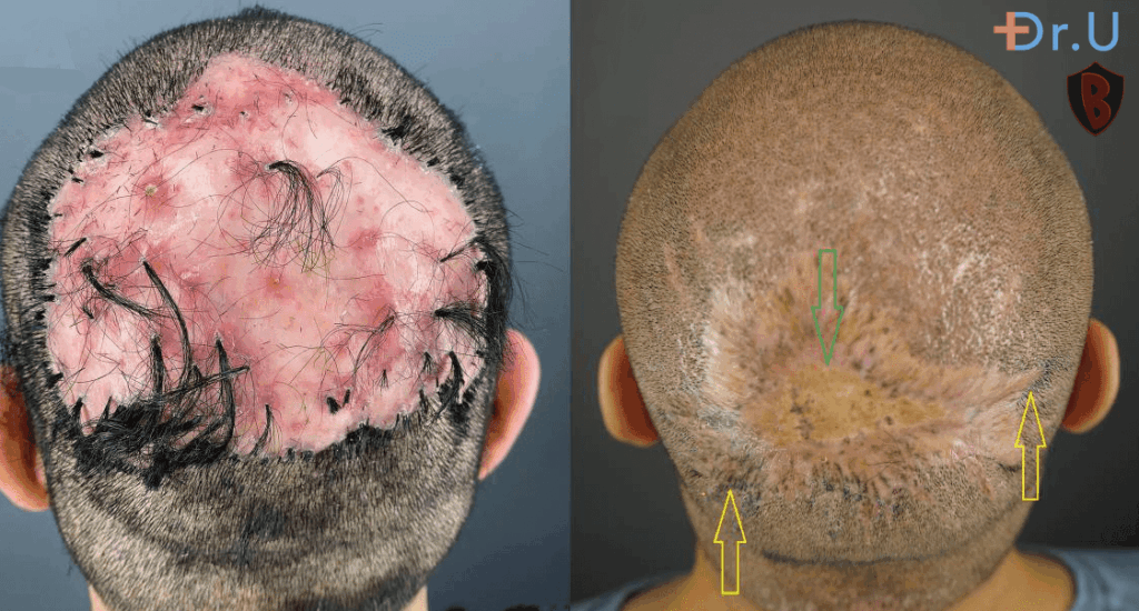 Preoperative FD plaque and AKN  (left). Nineteen months after complete excision of FD lesion and healing by second intention (right). *