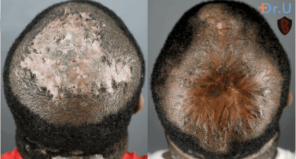 Preoperative FD plaque (left). Eight months after complete excision of FD lesion and healing by second intention (right). *