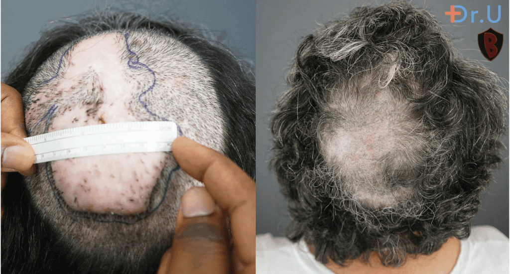 Preoperative FD plaque (left). Thirteen months after complete excision of FD lesion and healing by second intention (right). *