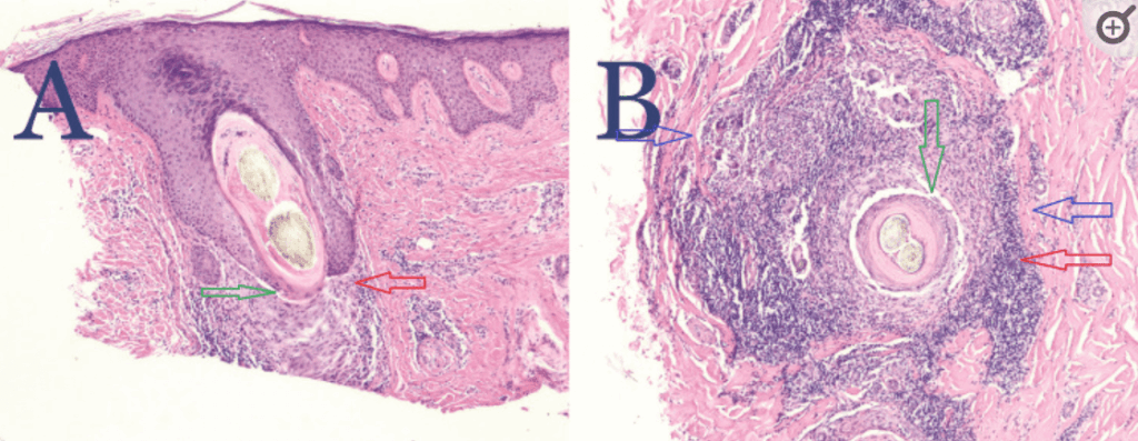 NAS biopsy showing PIILIF (A-vertical biopsy, B-horizontal biopsy). NAS biopsy showing PIILIF (A-vertical biopsy, B-horizontal biopsy).