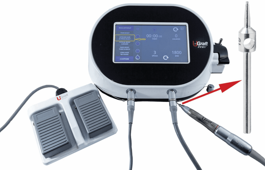 The UGraft Zeus device showing a handpiece, foot pedal, and a console with a dashboard highlighting (yellow) the thick-firm scalp preset selection and the torque (UForce) and rotational speed (RPM) dials. Inset shows a closer view of the punch (Red arrow). RPM, Revolution per minute. The UGraft Zeus device showing a handpiece, foot pedal, and a console with a dashboard highlighting (yellow) the thick-firm scalp preset selection and the torque (UForce) and rotational speed (RPM) dials. Inset shows a closer view of the punch (Red arrow). RPM, Revolution per minute.