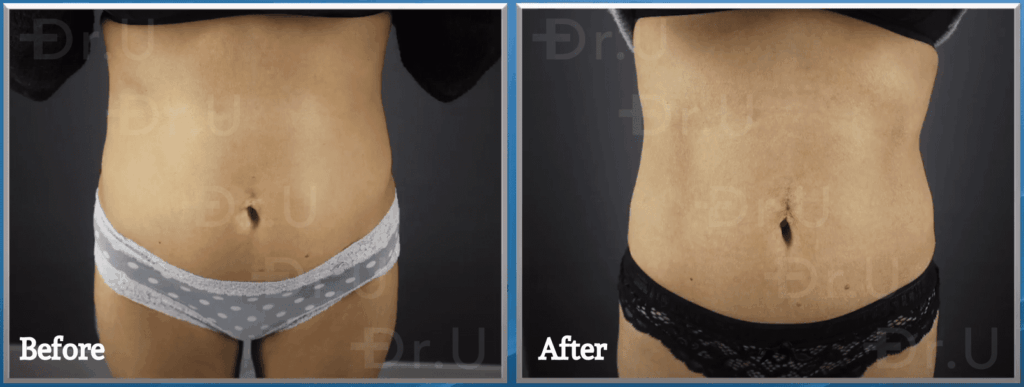 Emscupt treatment results. The patient was treated by Dr. Sanusi Umar at Dr. U Hair and Skin Clinic.