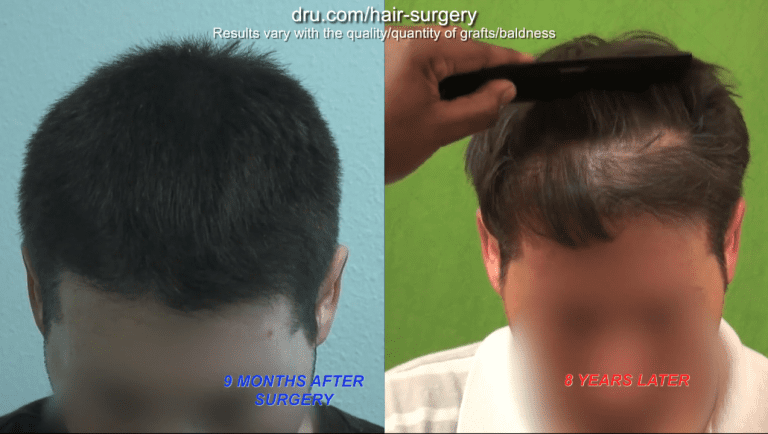 Patient from Dr U study who was FUE shave test positive and had nape and periauricular grafts used in crafting his hairline. Left photo - nine months after surgery. Right photo - eight years later.
Transplanted nape and periauricular hairline intact while the native frontal fringe receded. This demonstrates the long term validity of the FUE shave test
