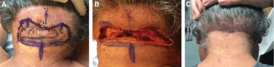 The patient had a large AKN lesion. (B) Immediately after the surgical removal of the lesion. (C) The patient 8 weeks post-procedure. 