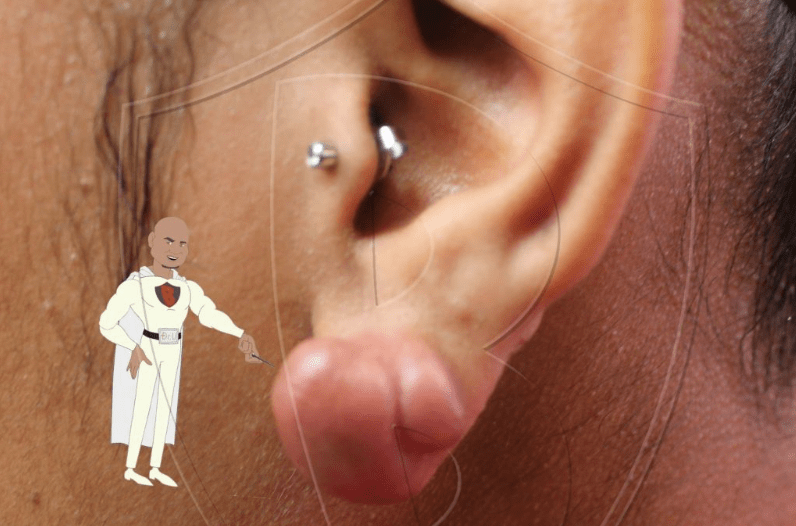 Because of piercings, ears are one of the more commonly affected areas by keloids. If you have keloid predisposition, ears are one of the more likely areas to be affected by keloids.