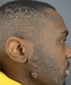 Ethnic background and skin color are some of the factors making someone more or less prone to keloids. Ethnic background and skin color are some of the factors playing a role in keloid predisposition.