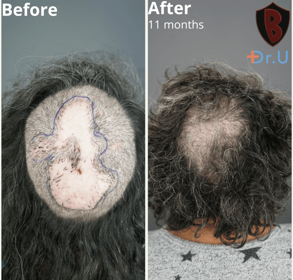 Maria’s AKN removal results 11 months post-surgery. *