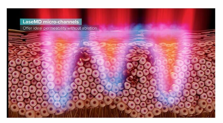 The precise Ultra laser creates microchannels that rejuvenate the skin and improve product absorption. Graphic from lutronic.com.