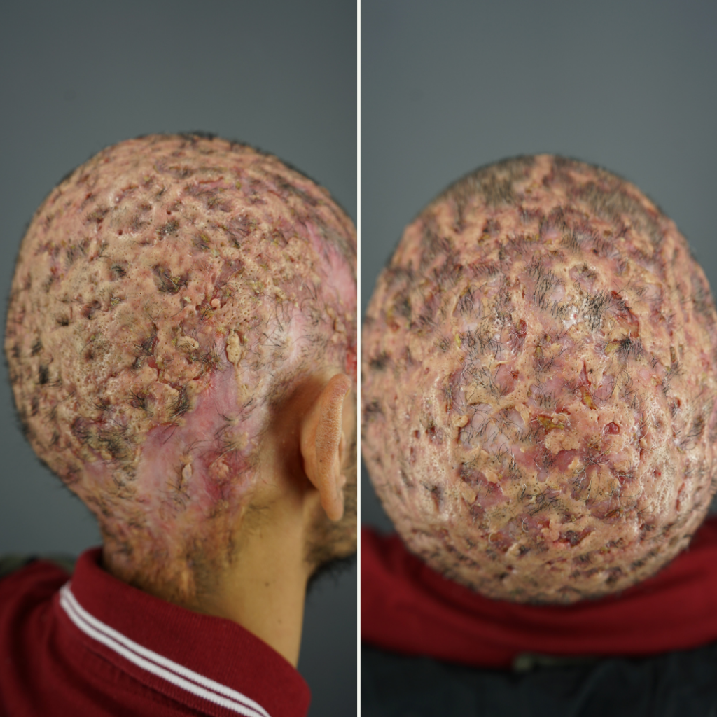 A patient with a very severe case of dissecting cellulitis. He is currently receiving laser treatment under the care of Dr. Umar to manage symptoms.
