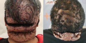 Patients with the Cutis Verticis Gyrata (CVG) and Acne Keloidalis Nuchae (AKN) conditions. Patients with the Cutis Verticis Gyrata (CVG) and Acne Keloidalis Nuchae (AKN) conditions.
