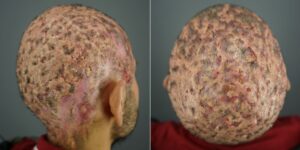 A patient with a very severe case of Dissecting Cellulitis (DC). A patient with a very severe case of Dissecting Cellulitis (DC).