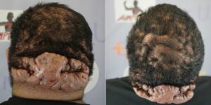 A patient with severe cutis verticis gyrata (CVG), acne keloidalis nuchae (AKN), and dissecting cellulitis (DC) conditions. A patient with severe cutis verticis gyrata (CVG), acne keloidalis nuchae (AKN), and dissecting cellulitis (DC) conditions.