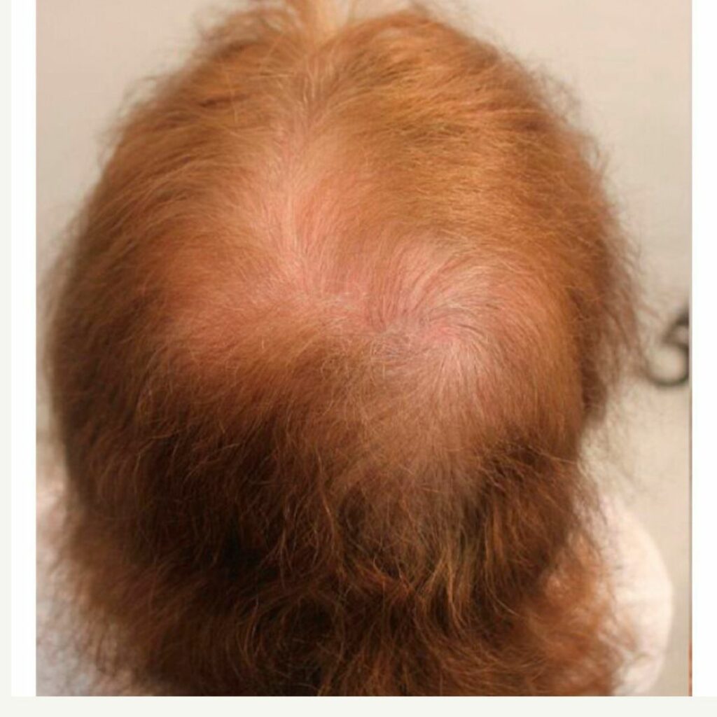 A patient with Androgenetic Alopecia (AGA)