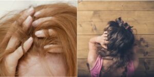 The images above depict the hair-pulling disorder in women. 
