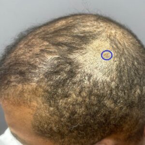 A patient with PIILIF during a biopsy examination by Dr. Umar.