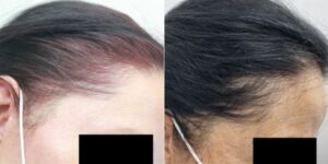 Frames A and B show patients with Frontal Fibrosing Alopecia. They used the Dr.UGro Gashee Natural Hair Products, created by Dr. Sanusi Umar. Frames A and B show patients with Frontal Fibrosing Alopecia. They used the Dr.UGro Gashee Natural Hair Products, created by Dr. Sanusi Umar.