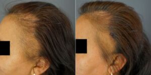Frames A and B show a patient with Frontal Fibrosing Alopecia. After using Dr.UGro Gashee Natural Hair Products, created by Dr. Sanusi Umar, the patient (as seen in Frame A) experienced hair regrowth. Frames A and B show a patient with Frontal Fibrosing Alopecia. After using Dr.UGro Gashee Natural Hair Products, created by Dr. Sanusi Umar, the patient (as seen in Frame A) experienced hair regrowth.