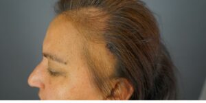 This patient with frontal fibrosing alopecia (FFA) is under the care of Dr. Sanusi Umar. This patient with frontal fibrosing alopecia (FFA) is under the care of Dr. Sanusi Umar.
