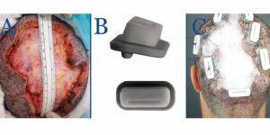 Frame A represents the patient's vertex immediately after surgical excision. Frame B shows suture guards used to secure the operated area to prevent tissue strangulation. Frame C is post-operation. Notice the use of high-tension suture guards.