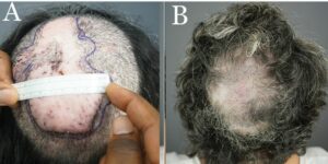 Preoperative FD plaque involving the vertex, mid-scalp extending to the frontal scalp. (A) Thirteen months after complete excision of FD lesion and healing by second intention, aided by high-tension sutures with guards and minor skin graft (B).