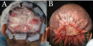 Frame A shows the patient after an operation and application of guarded high-tension sutures. Frame B is eight weeks post-operation. The doctor used a split-thickness skin graft from the inner thigh to close the open wound.